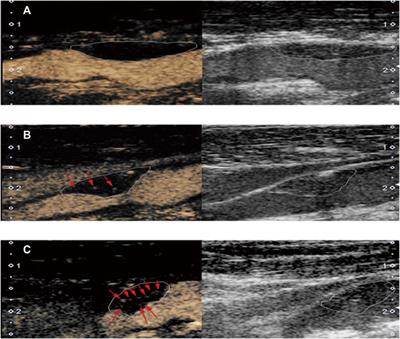 Carotid Intraplaque Neovascularization and Future Vascular Events in Patients With Asymptomatic Carotid Stenosis